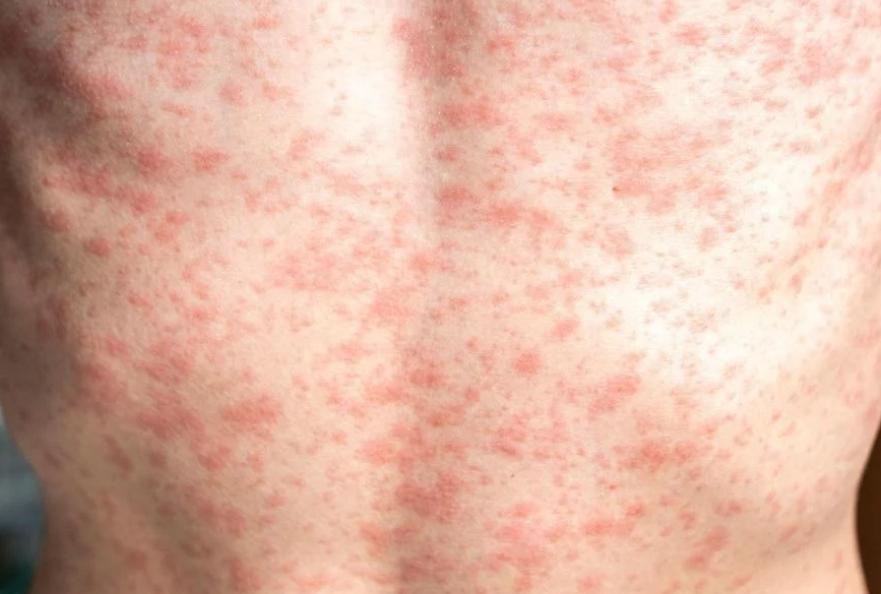 Measles confirmed in Reno County
